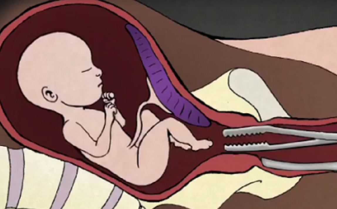 После выскабливания можно забеременеть. Вакуумная аспирация плода. Хирургический аборт плод. Рисунки искусственного прерывания беременности.